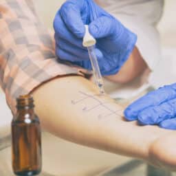 Close Up of a Patient Passing a Prick Scratch Allergy Test