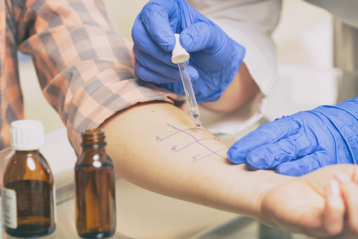 Close Up of a Patient Passing a Prick Scratch Allergy Test